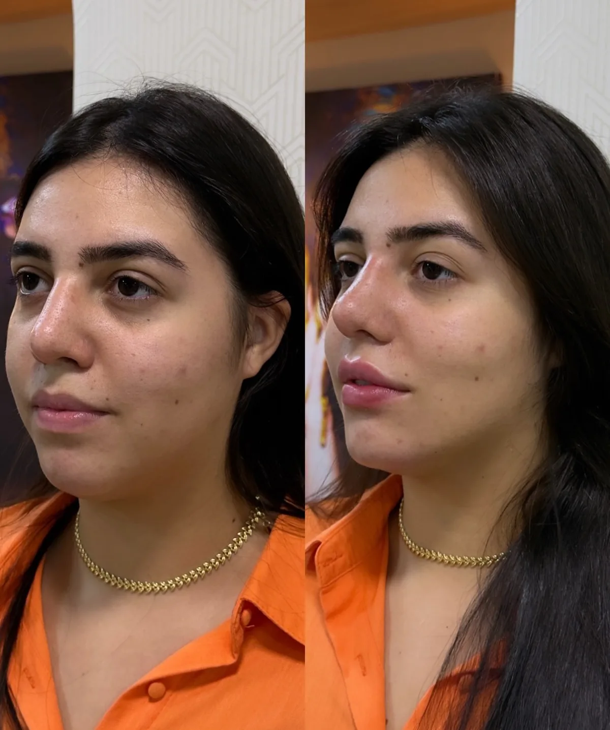 Harmonização orofacial, resultado 1