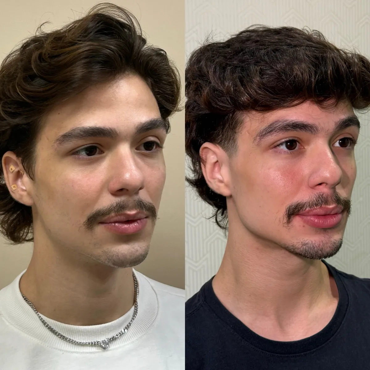 Harmonização orofacial, resultado 10