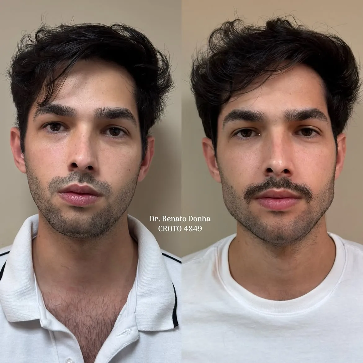 Harmonização orofacial, resultado 11