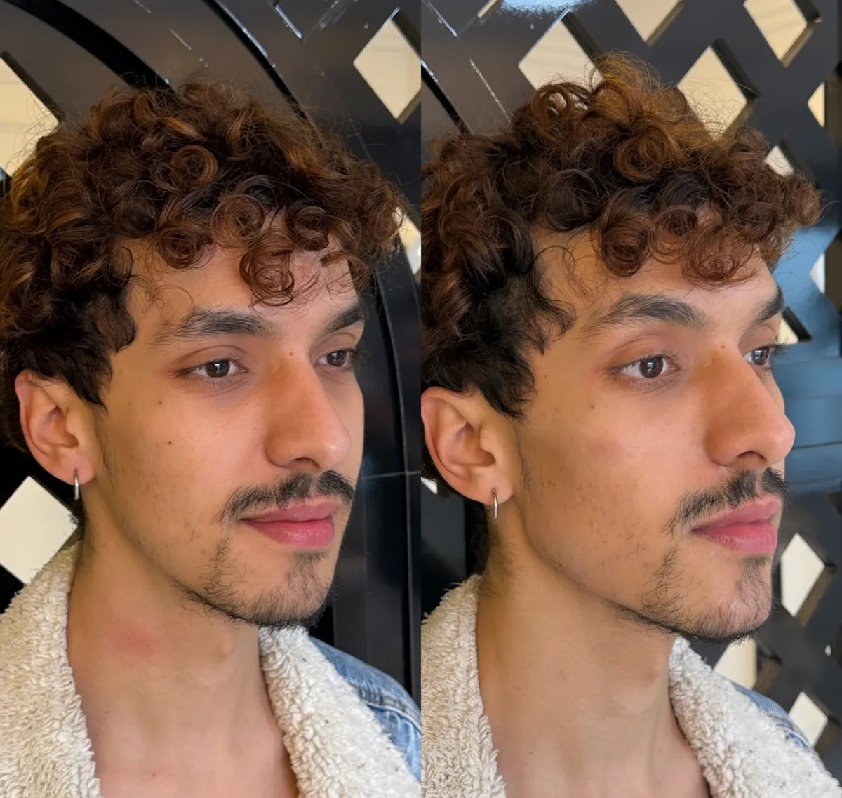 Harmonização orofacial, resultado 12