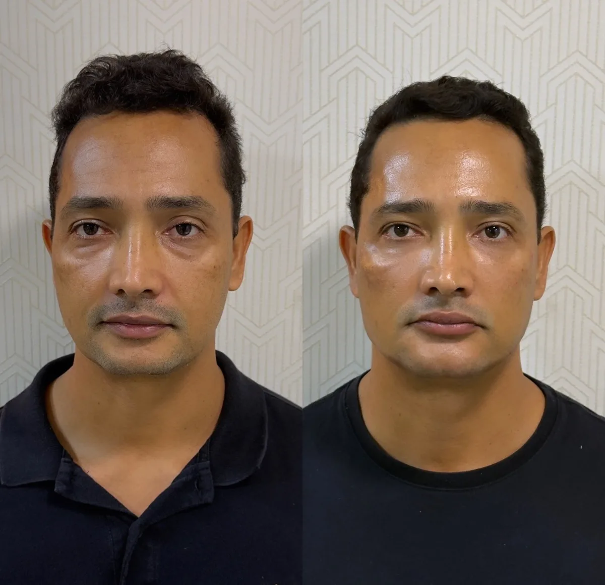 Harmonização orofacial, resultado 13