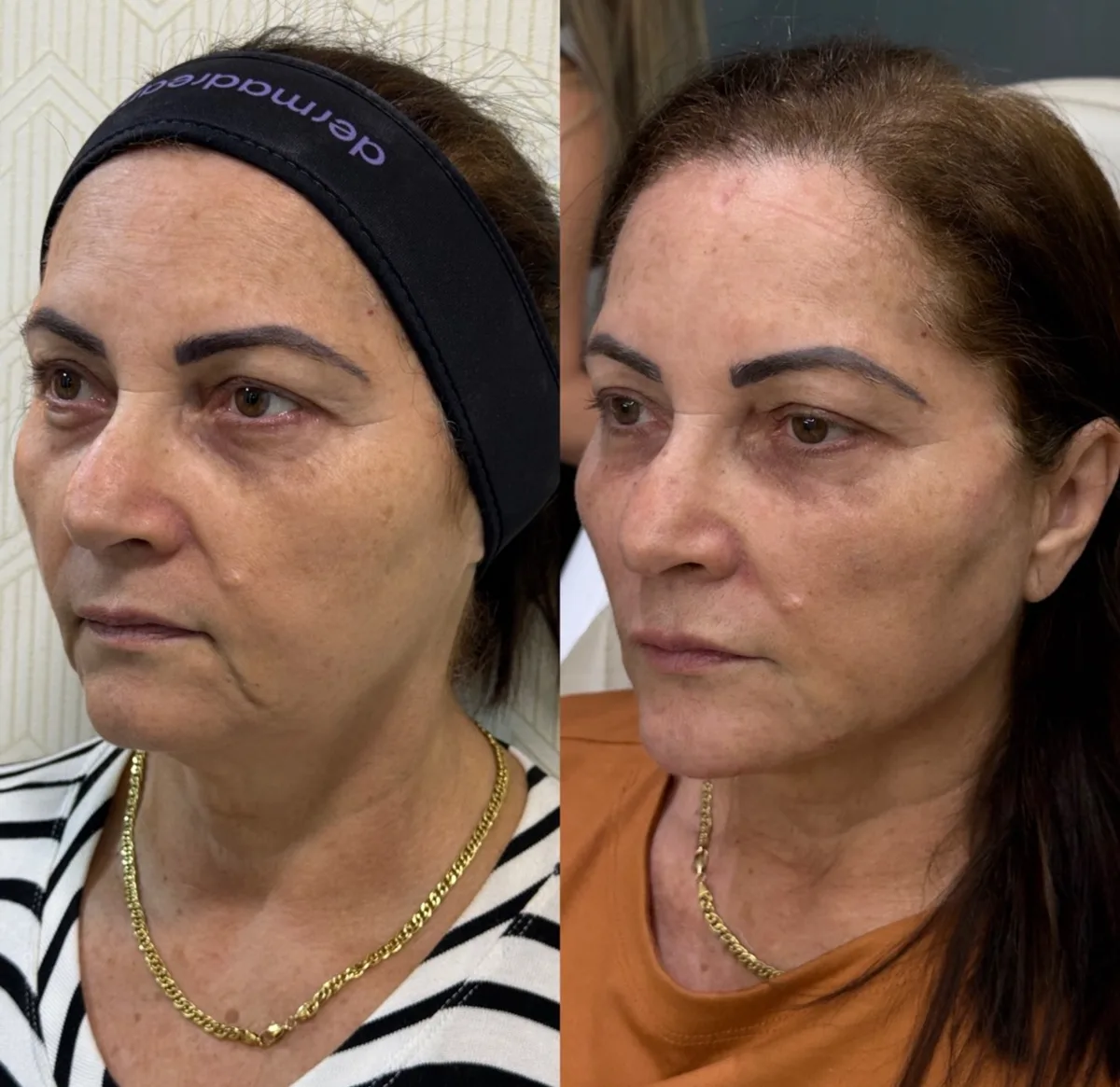 Harmonização orofacial, resultado 3