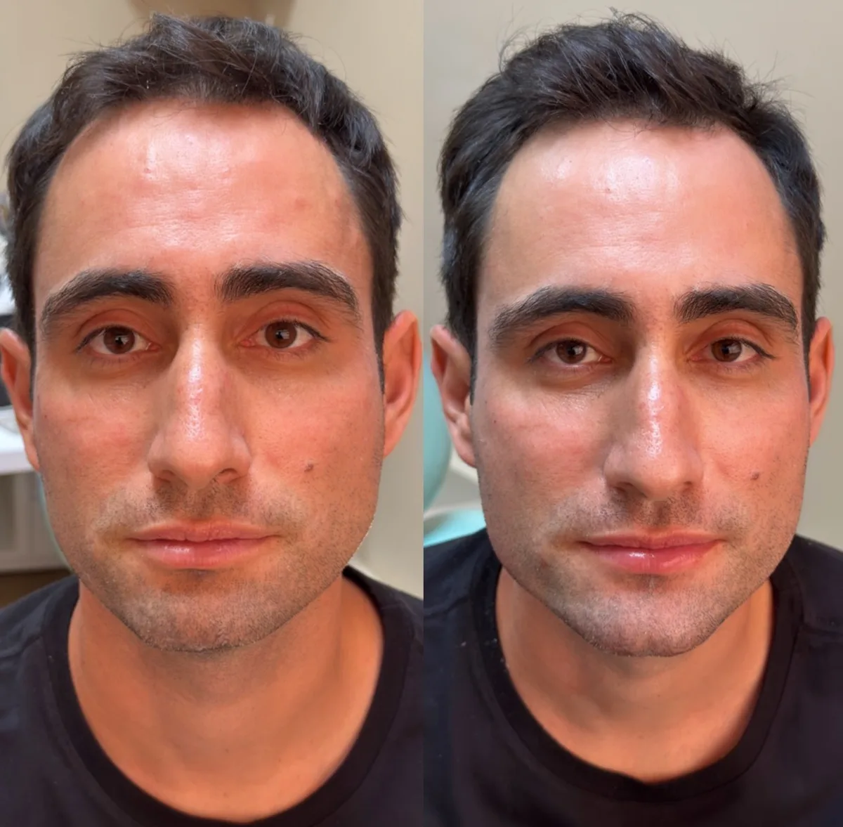 Harmonização orofacial, resultado 4