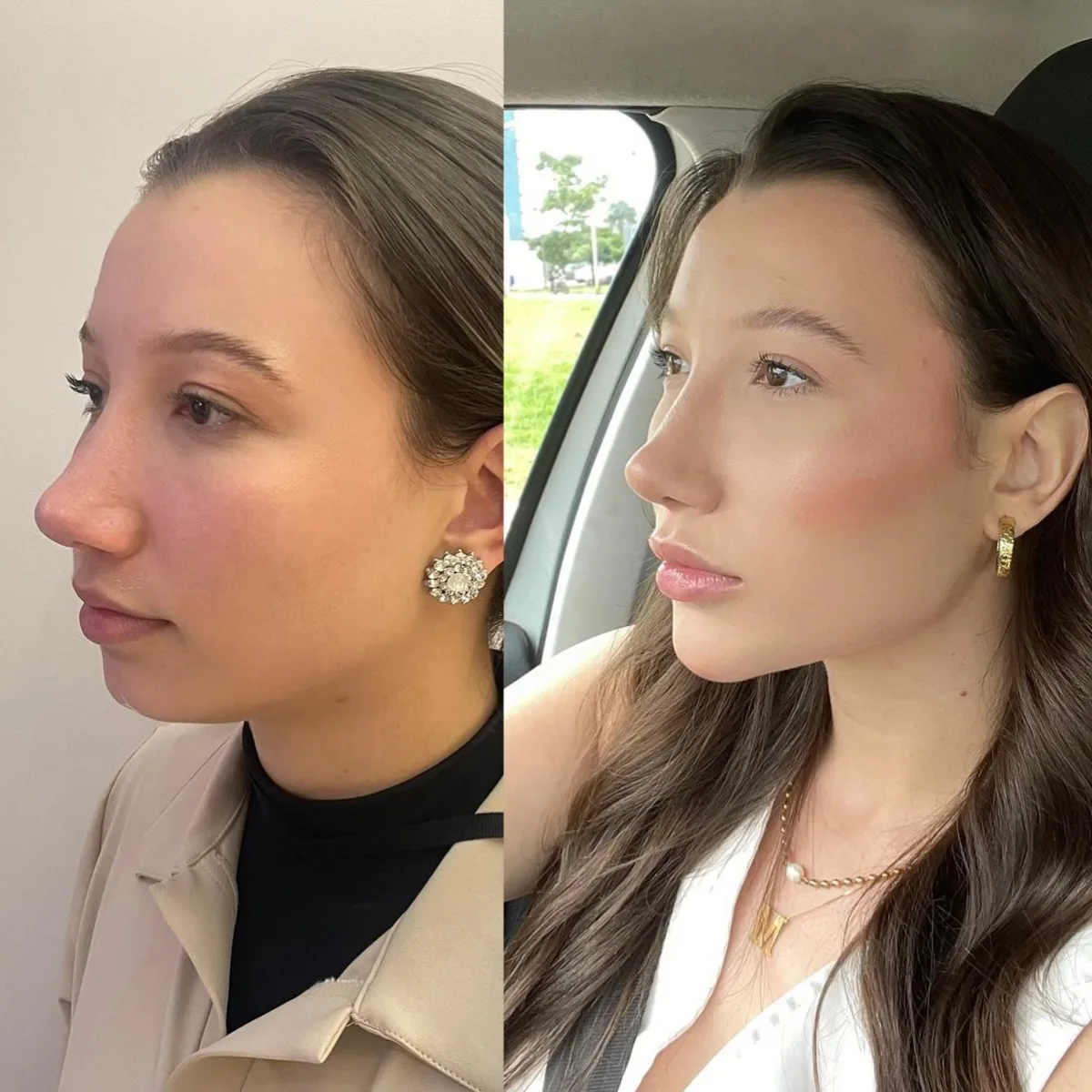 Harmonização orofacial, resultado 5