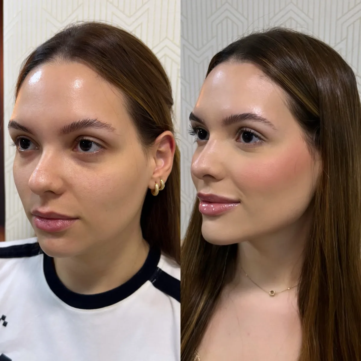 Harmonização orofacial, resultado 6