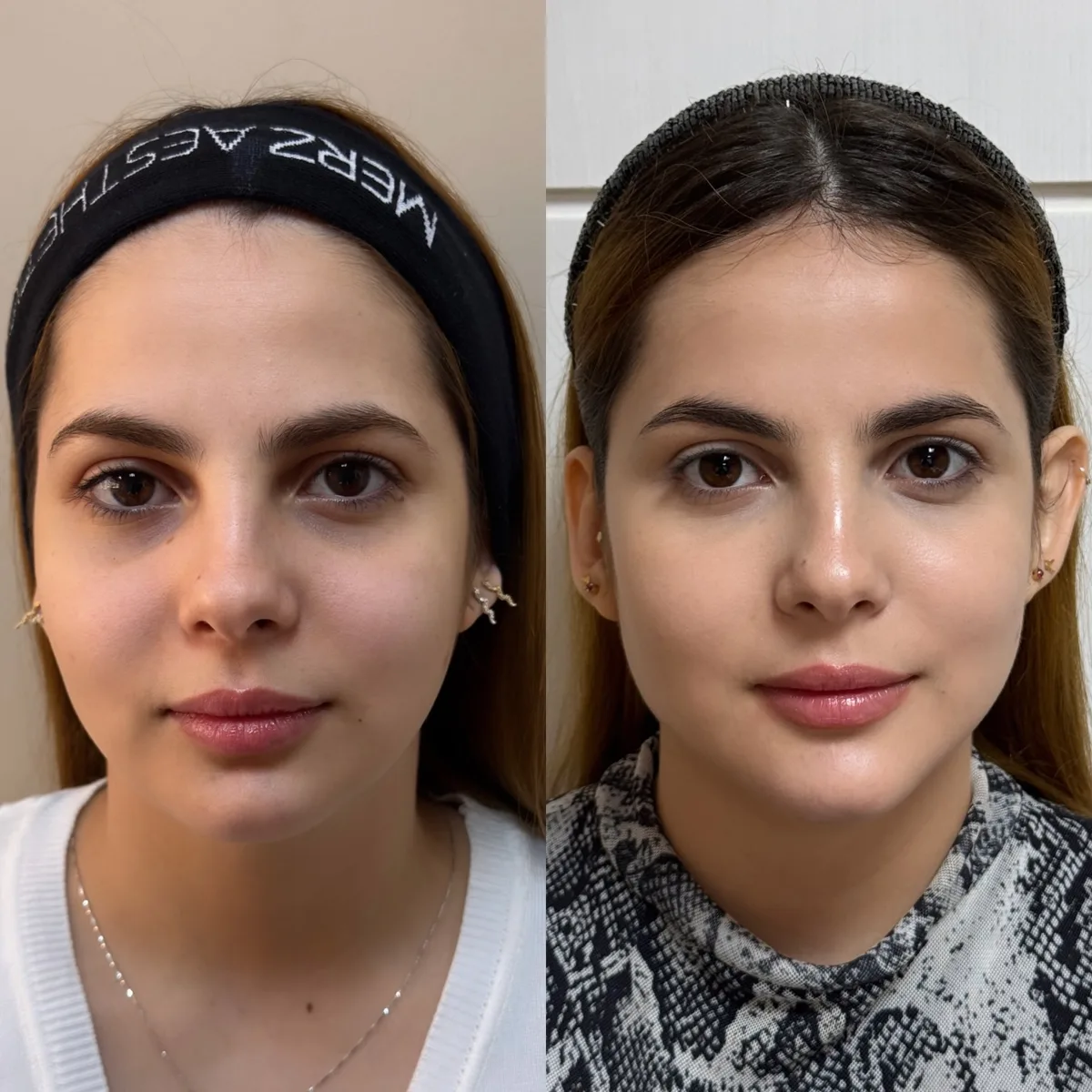 Harmonização orofacial, resultado 7