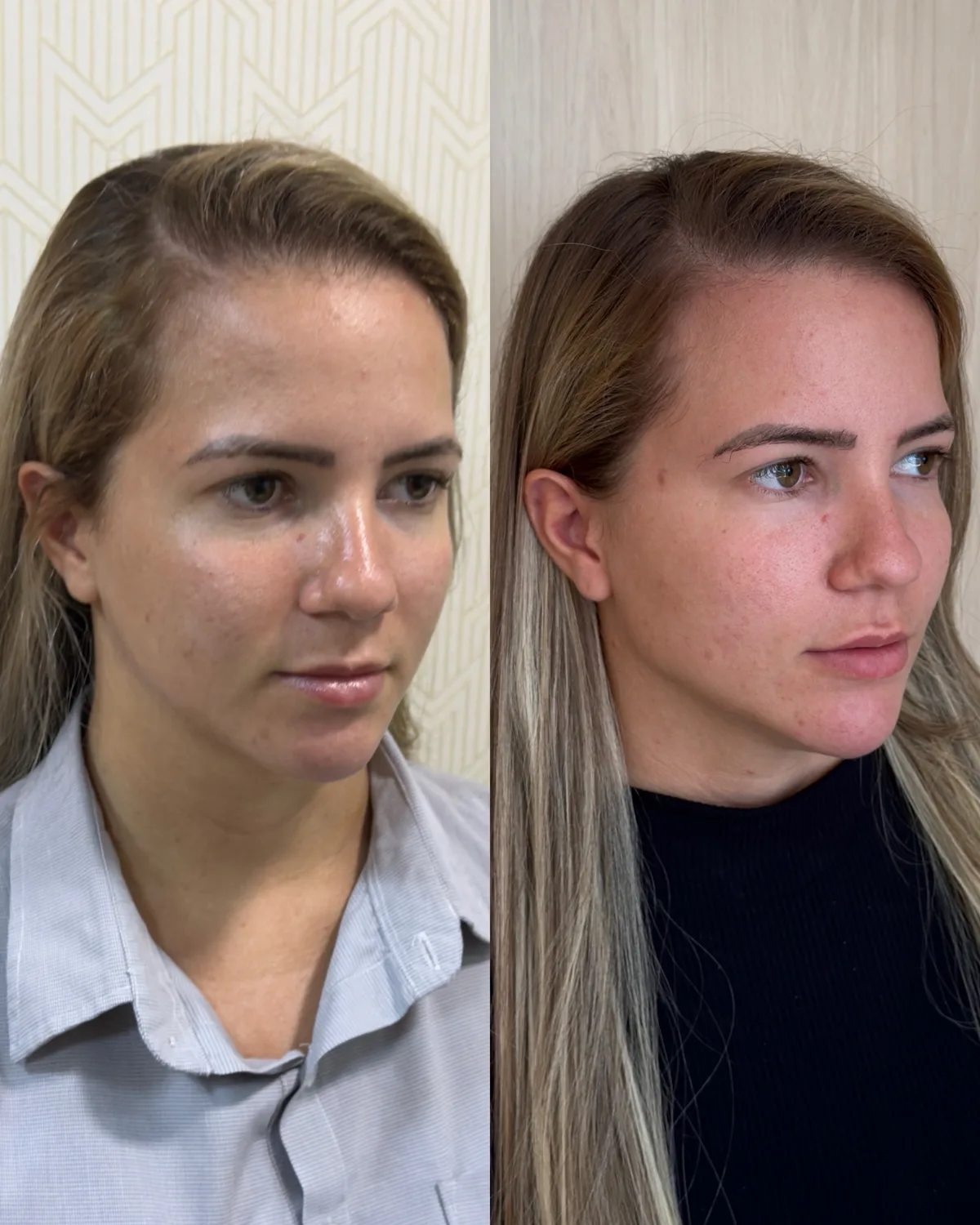 Harmonização orofacial, resultado 8