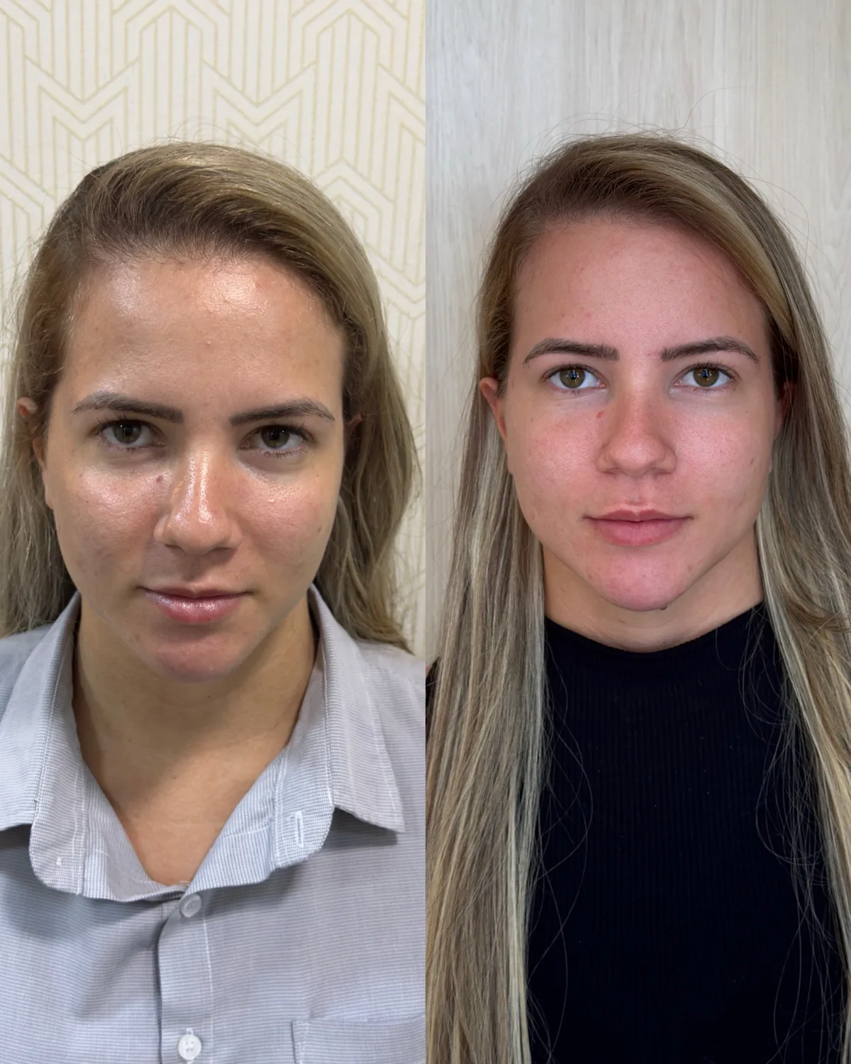 Harmonização orofacial, resultado 9